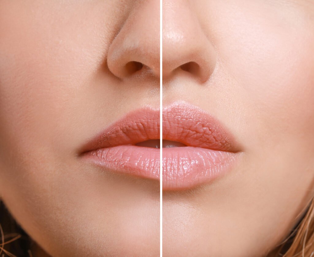 Lip augmentation treatment image